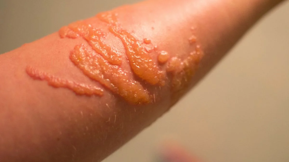 jellyfish bite Spain